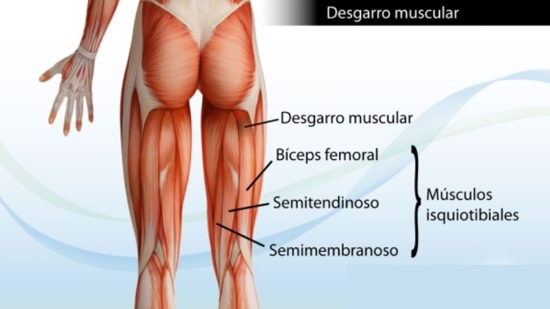 desgarroMuscular